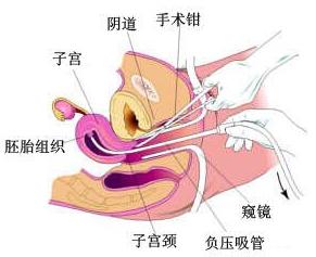 杭州怀孕了去哪打胎好